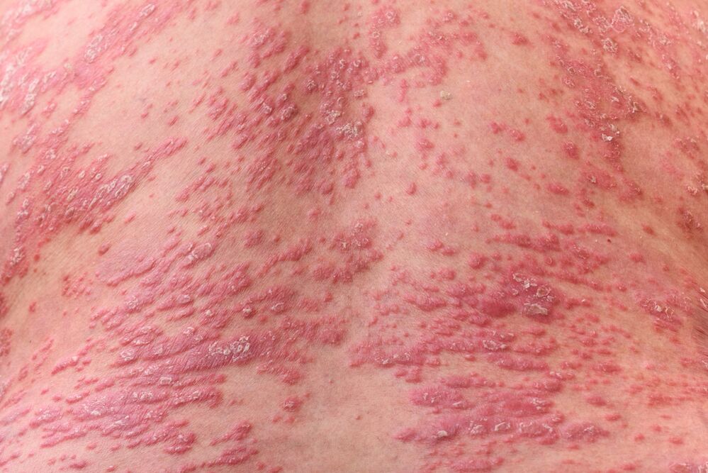 A quoi ressemble le psoriasis 