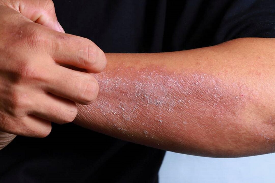 Symptômes du psoriasis